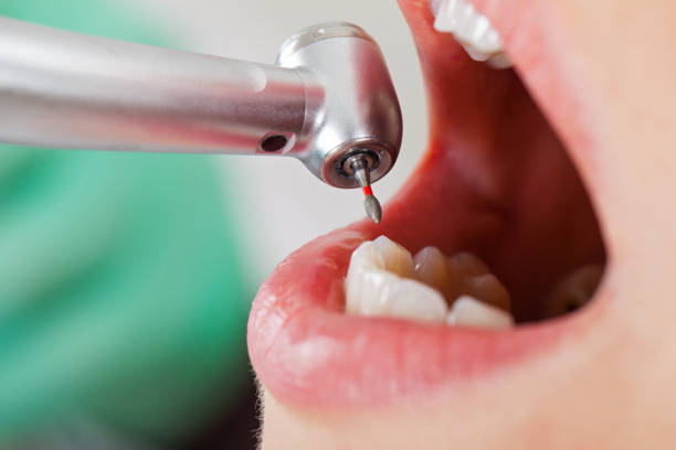 Best Emergency Dentist for Lost Fillings or Crowns in Hohenwald, TN